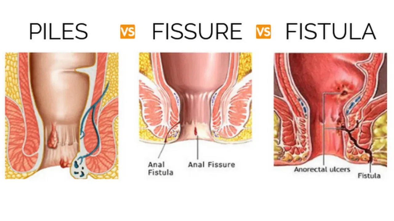 Hernia Surgery - Laser Piles - Laser Fissure - Laser Fistula