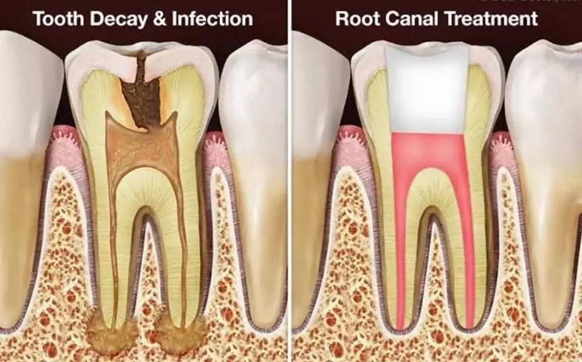Endodontics (RCT)