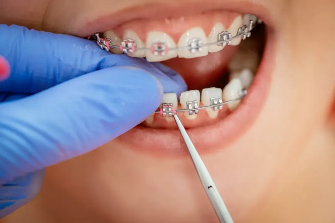 Orthodontics (Braces)