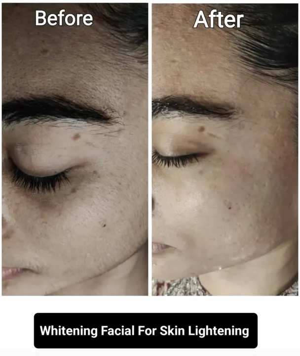 Whitening Facial For Skin Lightening