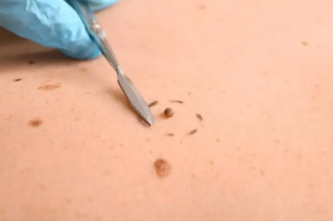 Mole, Skin Tag Treatment
