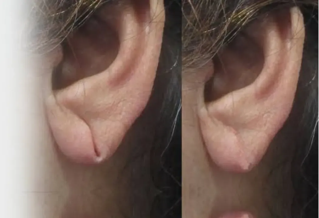 Ear Lob Repair Treatment