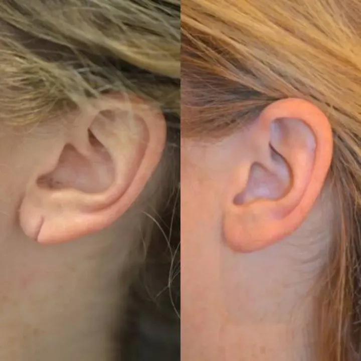 Ear Lob Repair Treatment